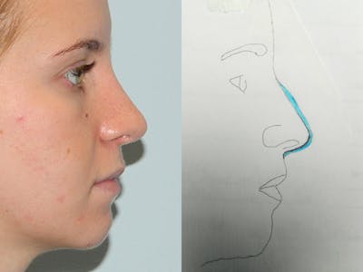 Rhinoplasty Before & After Gallery - Patient 133066615 - Image 2