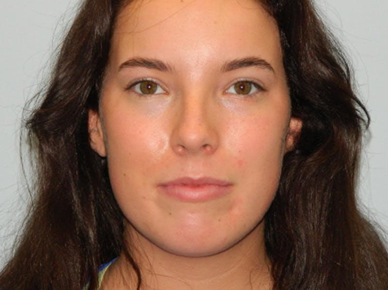 Chin Augmentation Before & After Gallery - Patient 133066614 - Image 7
