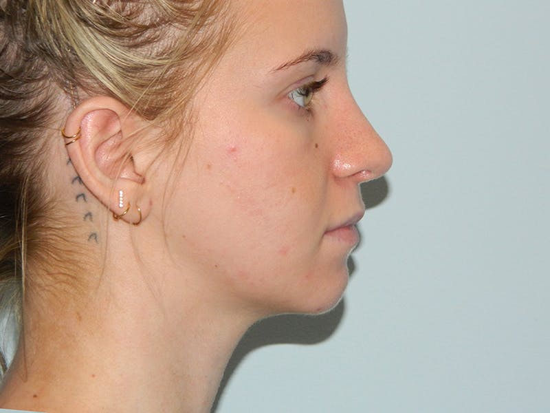 Rhinoplasty Before & After Gallery - Patient 133066615 - Image 4