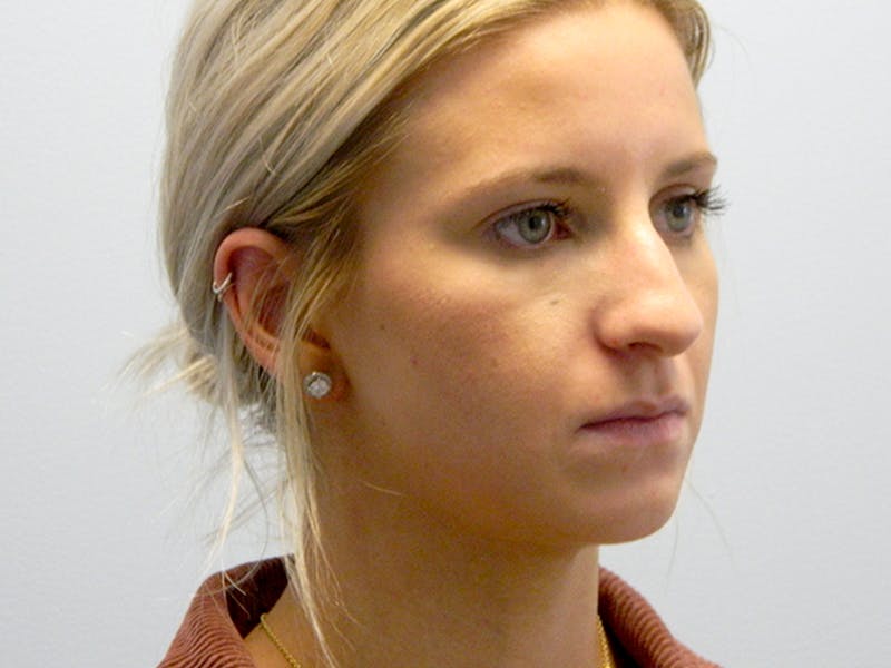 Rhinoplasty Before & After Gallery - Patient 133066615 - Image 5