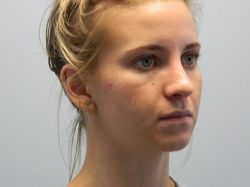 Rhinoplasty Before & After Gallery - Patient 133066615 - Image 6