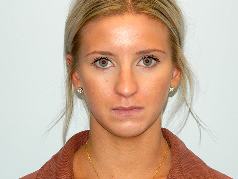 Rhinoplasty Before & After Gallery - Patient 133066615 - Image 7