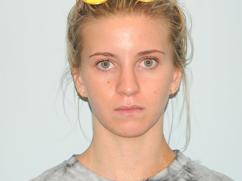 Rhinoplasty Before & After Gallery - Patient 133066615 - Image 8