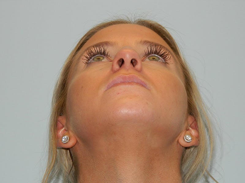 Rhinoplasty Before & After Gallery - Patient 133066615 - Image 9