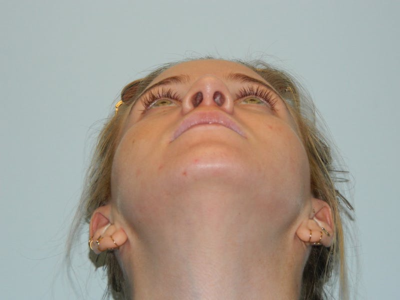 Rhinoplasty Before & After Gallery - Patient 133066615 - Image 10