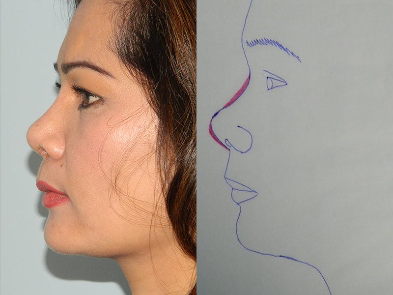 Rhinoplasty Before & After Gallery - Patient 133066617 - Image 2