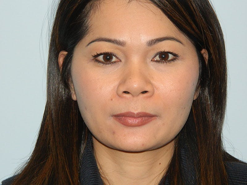 Rhinoplasty Before & After Gallery - Patient 133066617 - Image 5
