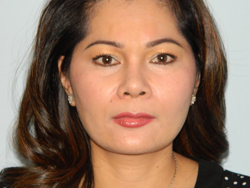 Rhinoplasty Before & After Gallery - Patient 133066617 - Image 6