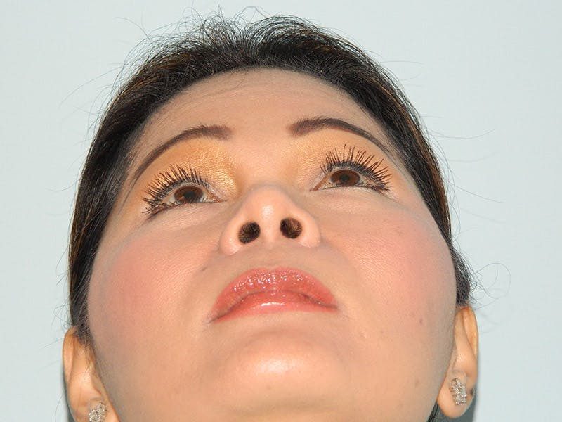 Rhinoplasty Before & After Gallery - Patient 133066617 - Image 8