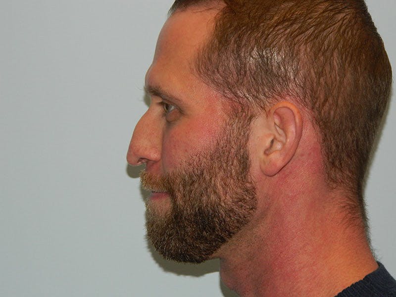 Rhinoplasty Before & After Gallery - Patient 133066618 - Image 1