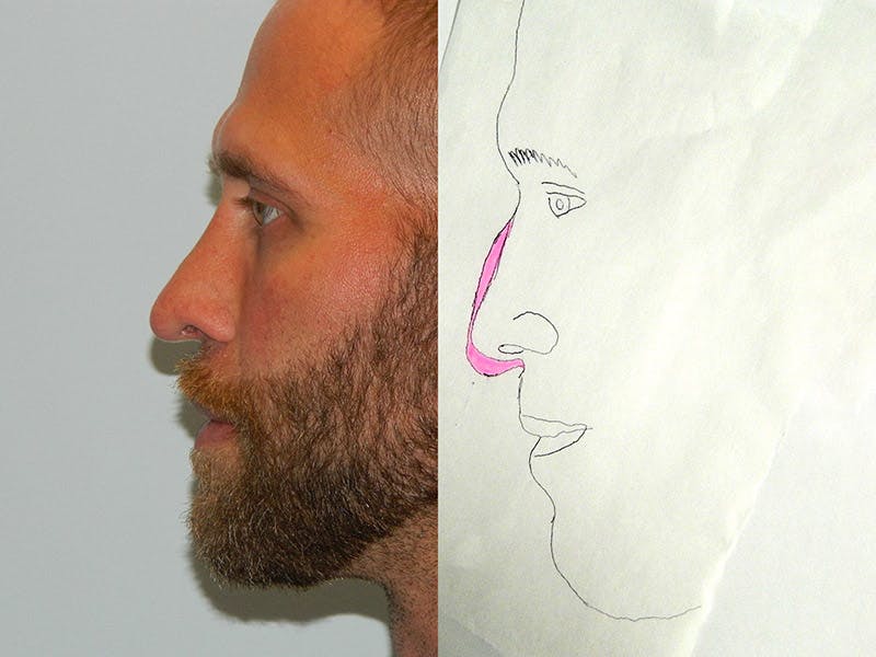Rhinoplasty Before & After Gallery - Patient 133066618 - Image 2