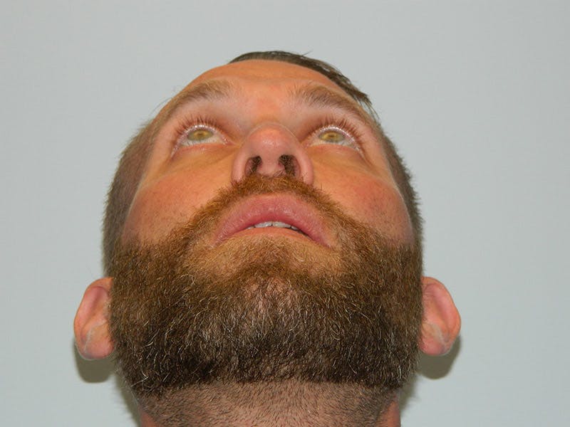 Rhinoplasty Before & After Gallery - Patient 133066618 - Image 6