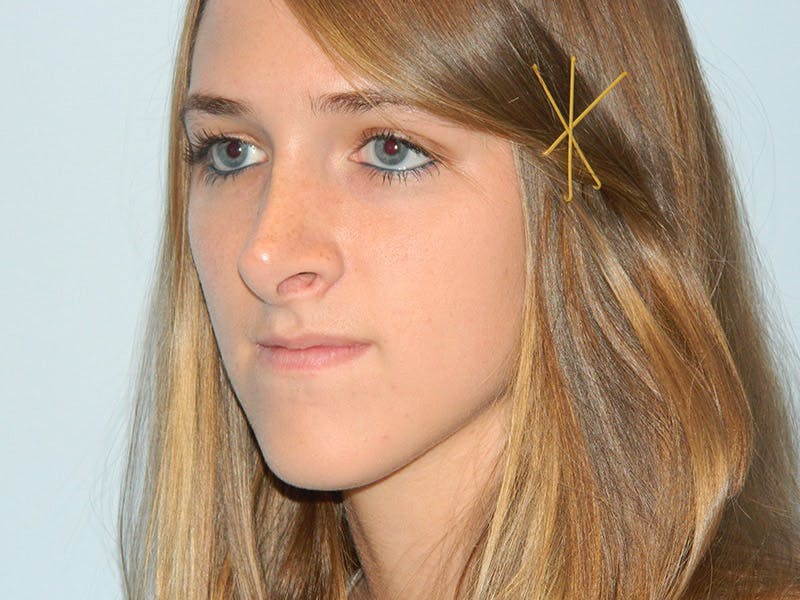 Rhinoplasty Before & After Gallery - Patient 133066619 - Image 5