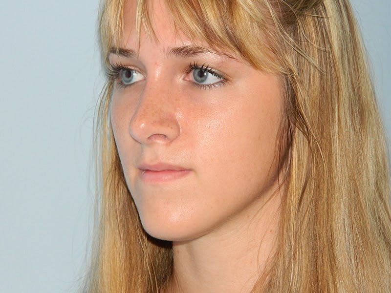 Rhinoplasty Before & After Gallery - Patient 133066619 - Image 6