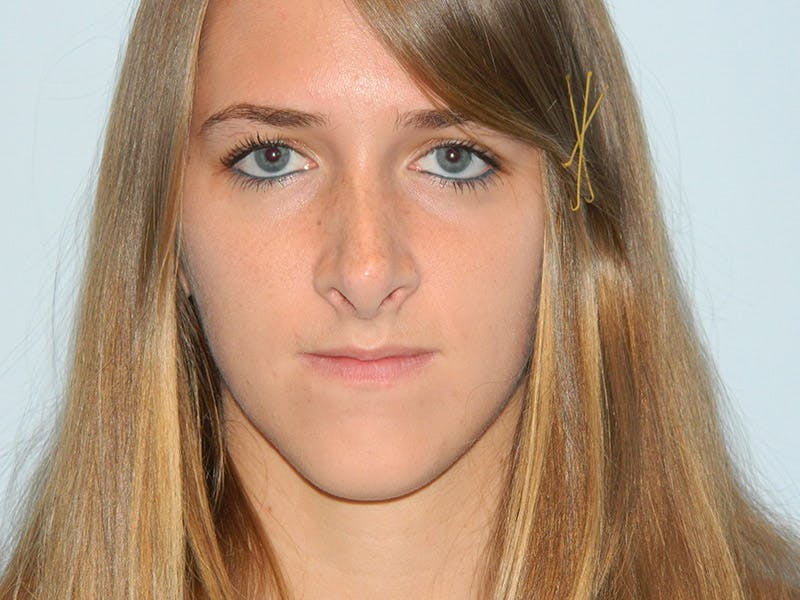 Rhinoplasty Before & After Gallery - Patient 133066619 - Image 7