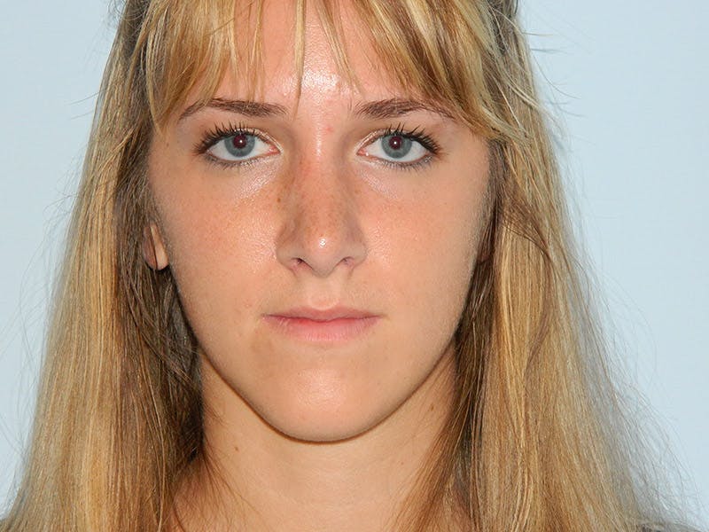 Rhinoplasty Before & After Gallery - Patient 133066619 - Image 8