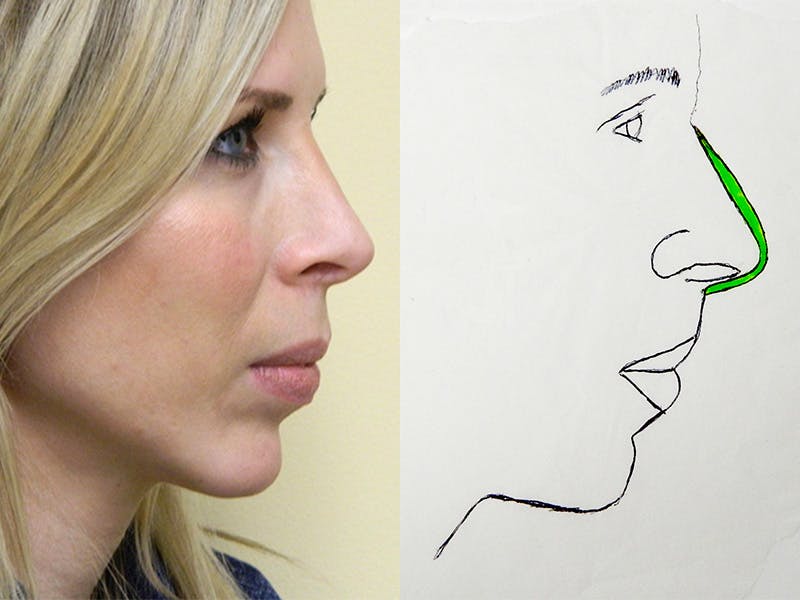 Rhinoplasty Before & After Gallery - Patient 133066622 - Image 2