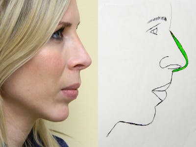 Rhinoplasty Before & After Gallery - Patient 133066622 - Image 2
