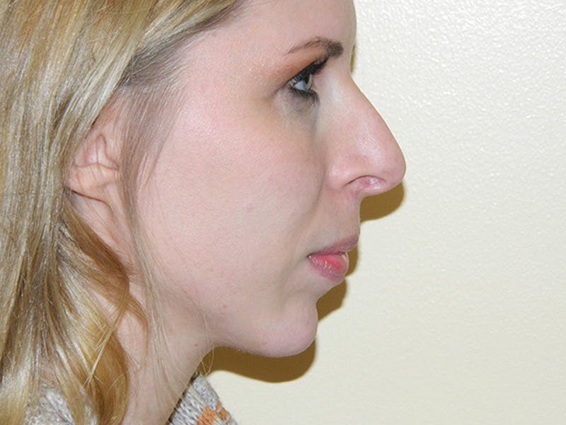 Rhinoplasty Before & After Gallery - Patient 133066622 - Image 3