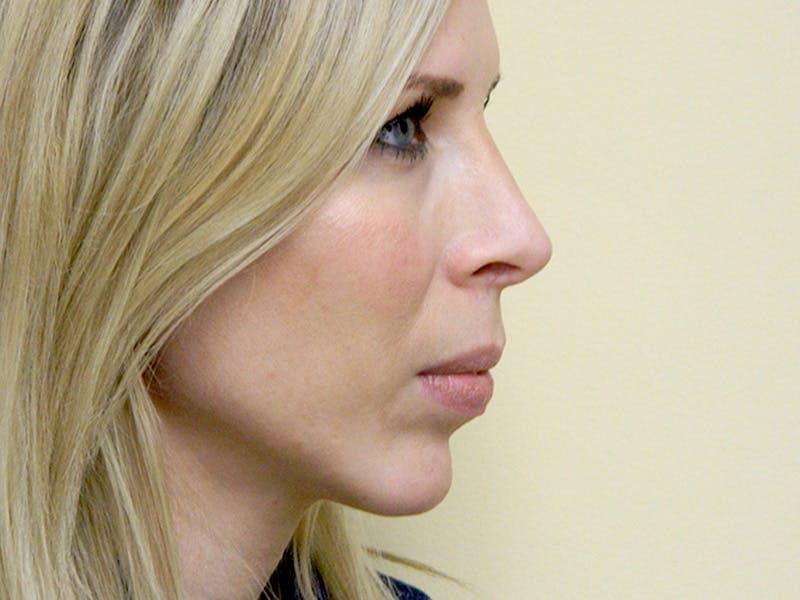 Rhinoplasty Before & After Gallery - Patient 133066622 - Image 4