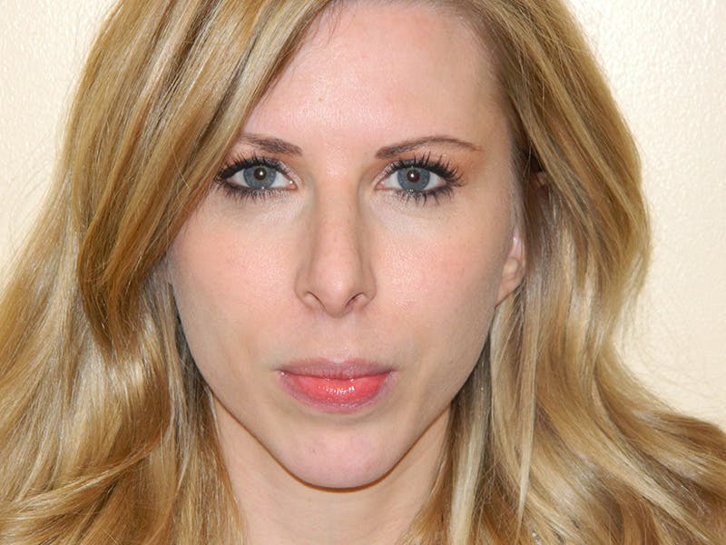 Rhinoplasty Before & After Gallery - Patient 133066622 - Image 7