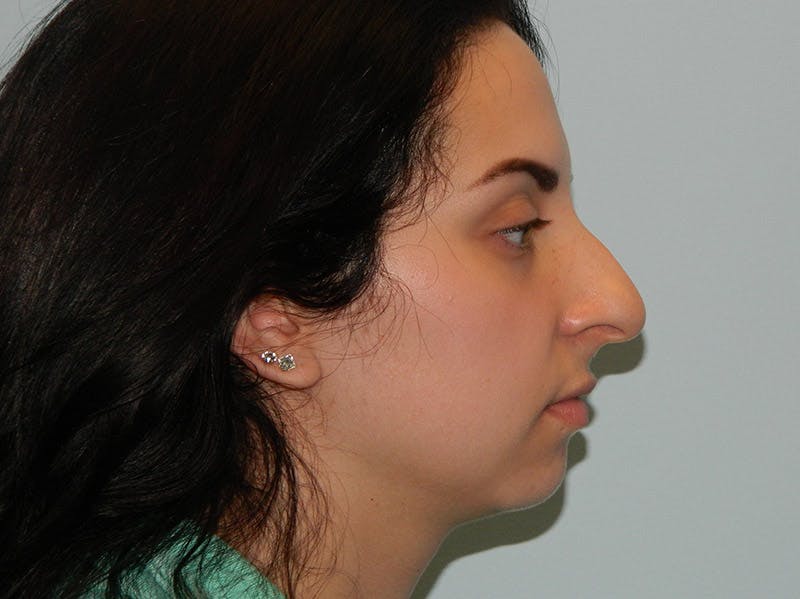 Rhinoplasty Before & After Gallery - Patient 133066623 - Image 1