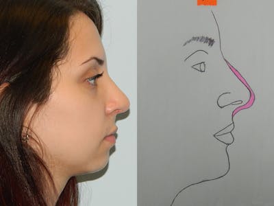 Rhinoplasty Before & After Gallery - Patient 133066623 - Image 2