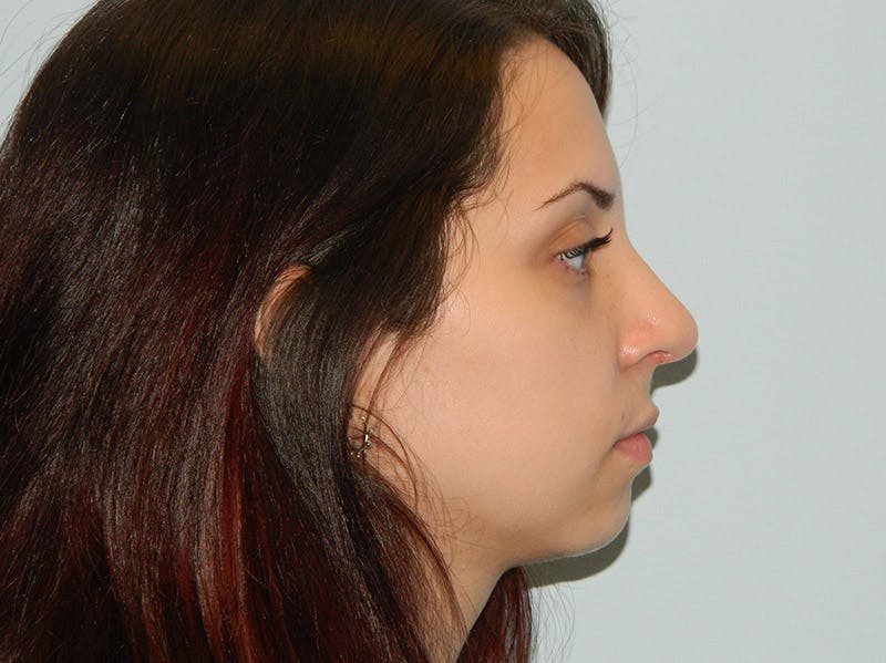 Rhinoplasty Before & After Gallery - Patient 133066623 - Image 4