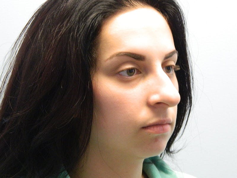 Rhinoplasty Before & After Gallery - Patient 133066623 - Image 5