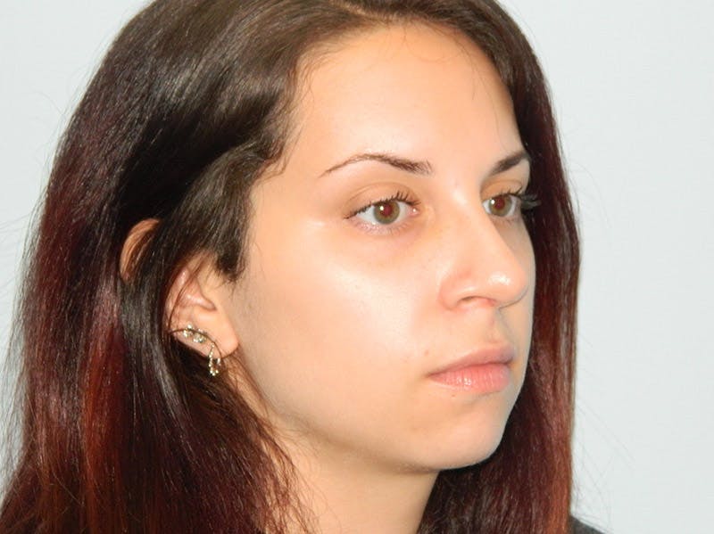 Rhinoplasty Before & After Gallery - Patient 133066623 - Image 6