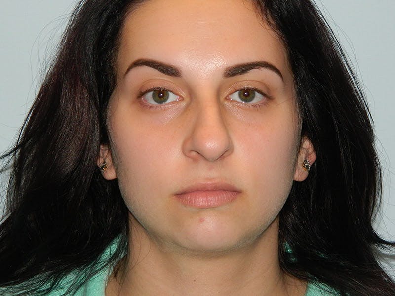 Rhinoplasty Before & After Gallery - Patient 133066623 - Image 7