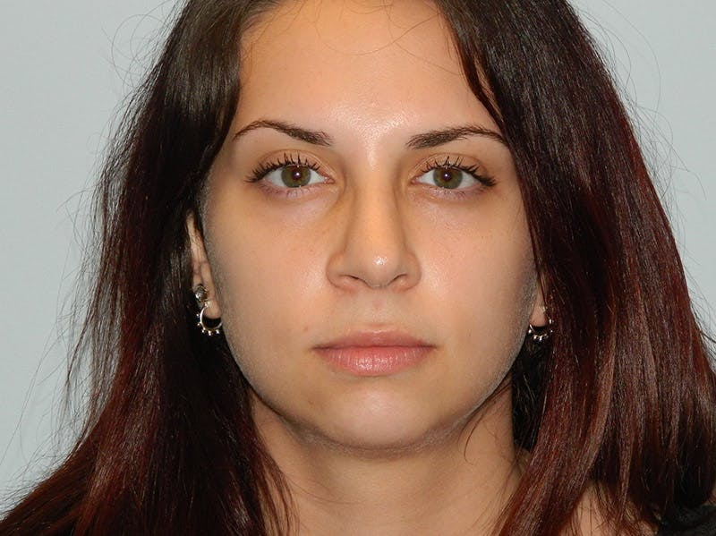Rhinoplasty Before & After Gallery - Patient 133066623 - Image 8
