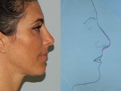 Rhinoplasty Before & After Gallery - Patient 133066624 - Image 2