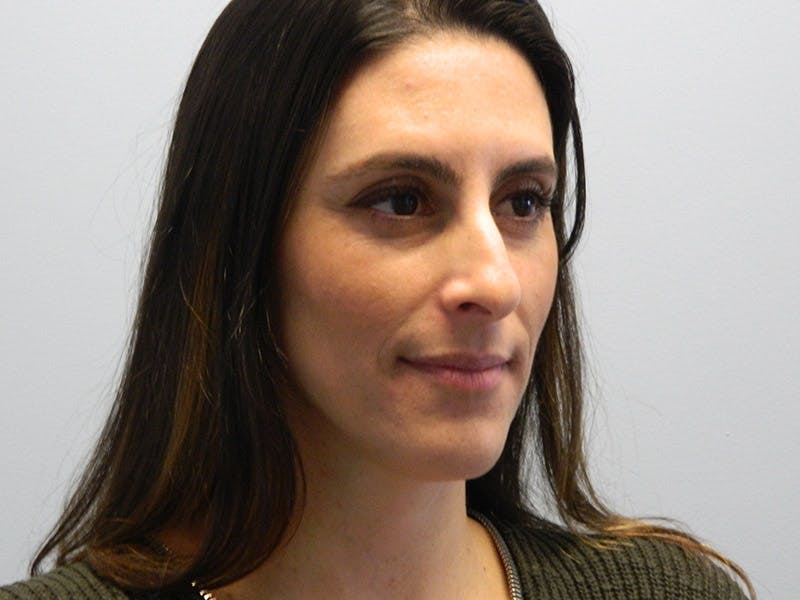 Rhinoplasty Before & After Gallery - Patient 133066624 - Image 3