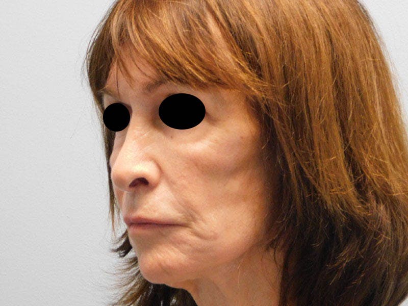 Rhinoplasty Before & After Gallery - Patient 133066626 - Image 5