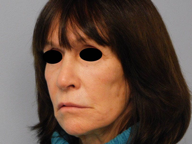 Rhinoplasty Before & After Gallery - Patient 133066626 - Image 6