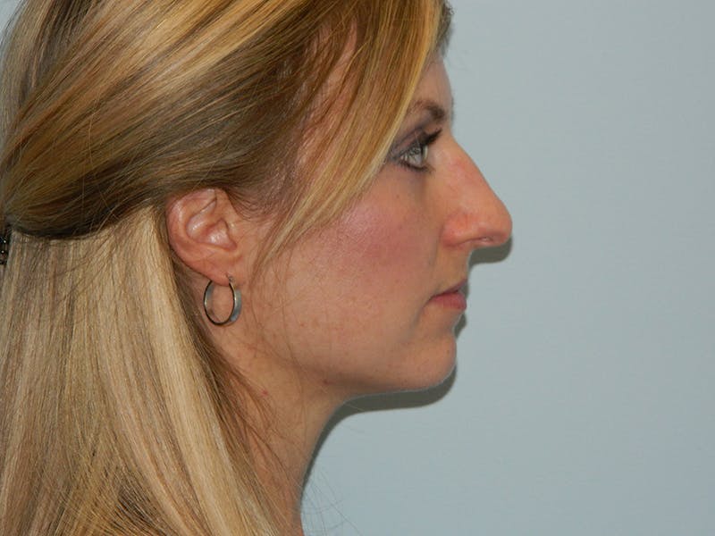 Rhinoplasty Before & After Gallery - Patient 133066629 - Image 1