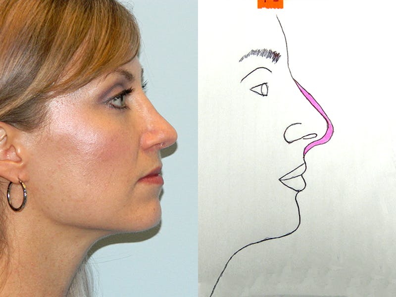 Rhinoplasty Before & After Gallery - Patient 133066629 - Image 2