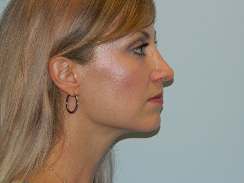 Rhinoplasty Before & After Gallery - Patient 133066629 - Image 4