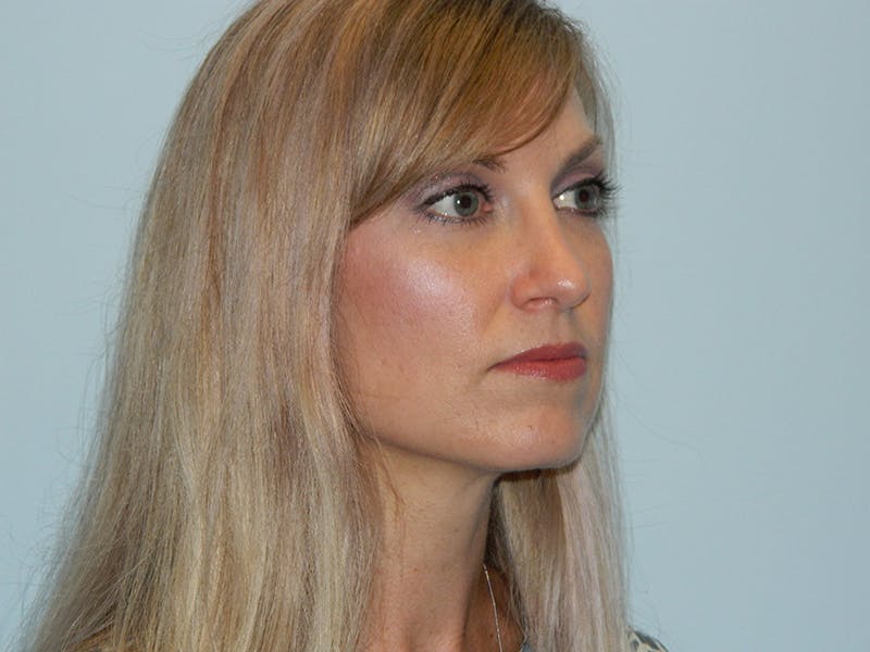Rhinoplasty Before & After Gallery - Patient 133066629 - Image 6