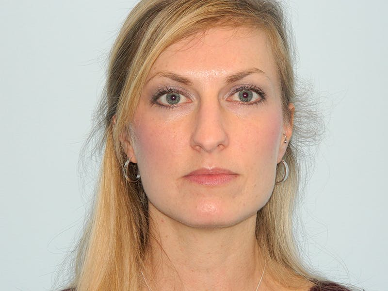 Rhinoplasty Before & After Gallery - Patient 133066629 - Image 7