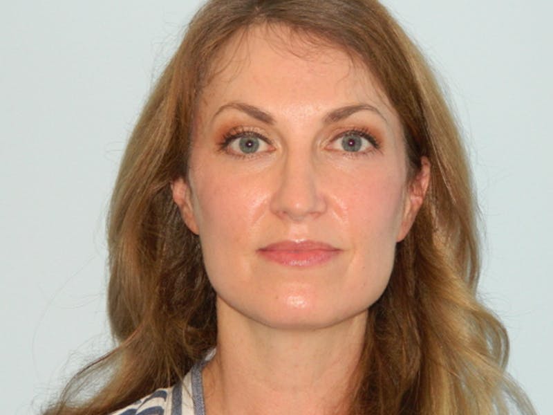 Rhinoplasty Before & After Gallery - Patient 133066629 - Image 8