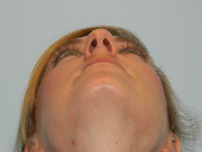 Rhinoplasty Before & After Gallery - Patient 133066629 - Image 9