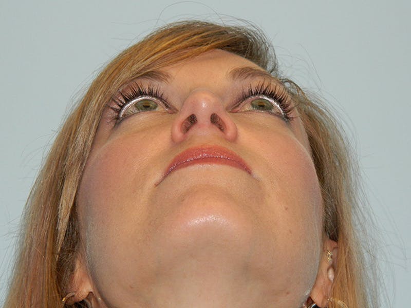 Rhinoplasty Before & After Gallery - Patient 133066629 - Image 10