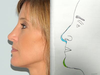 Rhinoplasty Before & After Gallery - Patient 133066631 - Image 2