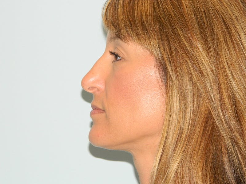 Rhinoplasty Before & After Gallery - Patient 133066631 - Image 3