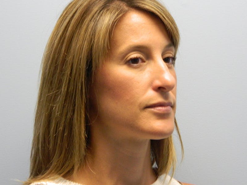 Rhinoplasty Before & After Gallery - Patient 133066631 - Image 5