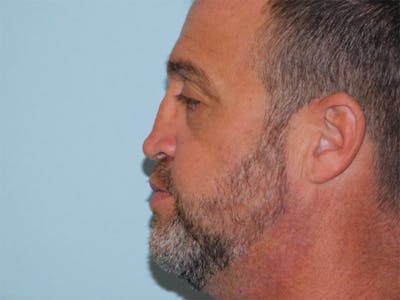 Rhinoplasty Before & After Gallery - Patient 133066634 - Image 1