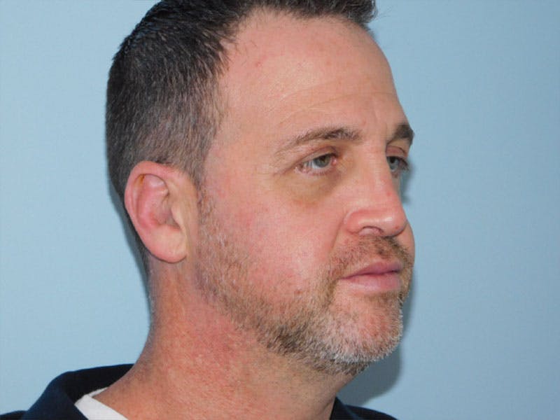 Rhinoplasty Before & After Gallery - Patient 133066634 - Image 6
