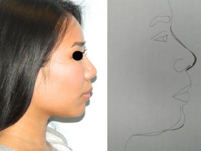 Rhinoplasty Before & After Gallery - Patient 133066636 - Image 2